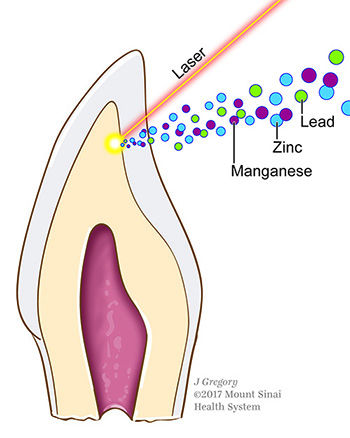 Cross-section of tooth showing laser removal of the dentine layer, in tan, for analysis of metal content