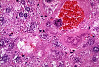 Intrahepatocyte Erythrocytes