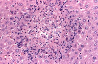 necrosis with a more pronounced inflammation cell infiltration at the periphery of the necrotic hepatocytes