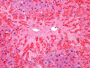an example of centrilobular hepatocellular necrosis with associated hemorrhage sometimes referred to as hemorrhagic necrosis