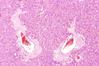 amyloid deposition in mouse liver