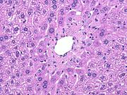 large areas of fatty change liver