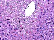 large areas of fatty change liver