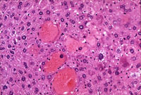 Intrahepatocyte Erythrocytes