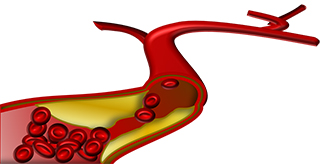 blockage in blood vessel