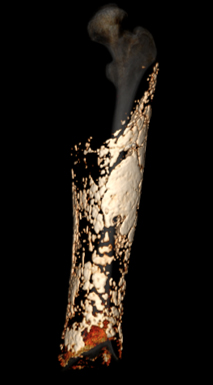 Computed tomography image of calcinosis.