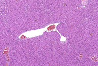 Intravascular hepatocytes