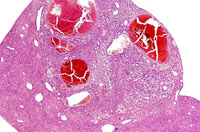 hemangiosarcoma