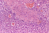 example of focal necrosis