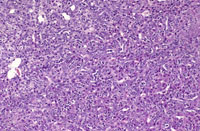 oval cell hyperplasia