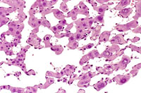 hemangiosarcoma