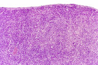 hepatocholangiocarcinoma