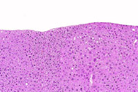 eosinophilic adenoma