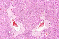 amyloid deposition in mouse liver