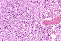 angiectasis low magnification