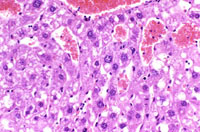 angiectasis low magnification