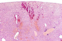 angiectasis low magnification