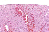 angiectasis low magnification