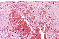 angiectasis low magnification