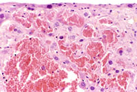 angiectasis low magnification