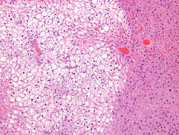 fatty change in liver