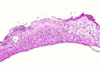 Chronic Inflammation