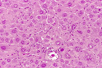Generalized hepatocyte hypertrophy involving all portions of the hepatic lobule. Higher magnification shows a cytomegalic hepatocyte in the lower right. It has an enlarged nucleus with multiple nucleoli.