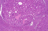 Hepatocellular Carcinoma