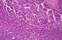 Hepatocellular Carcinoma