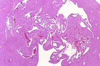 hemangiosarcoma