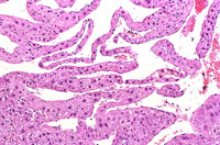 hemangiosarcoma