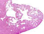 example of hemangioma