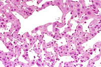 hemangiosarcoma