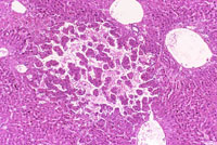 hemangiosarcoma
