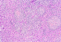 Histiocytic Sarcoma