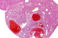 hemangiosarcoma