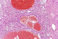 hemangiosarcoma
