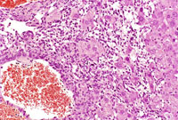 hemangiosarcoma