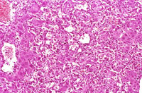 hemangiosarcoma