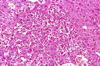 hemangiosarcoma