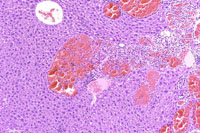 hemangiosarcoma