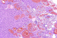 hemangiosarcoma