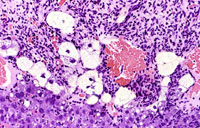 hemangiosarcoma