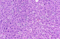 kupffer cell hyperplasia