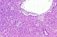 kupffer cell hyperplasia