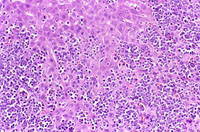 malignant lymphocytes