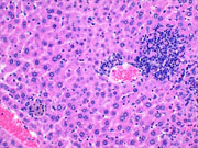 large areas of fatty change liver