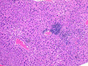 large areas of fatty change liver