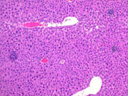 large areas of fatty change liver