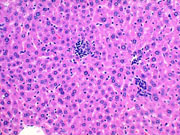 large areas of fatty change liver